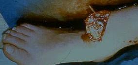 gebroken vinger
