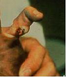 gebroken vinger